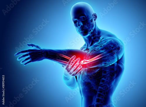 3d illustration of human elbow injury. photo