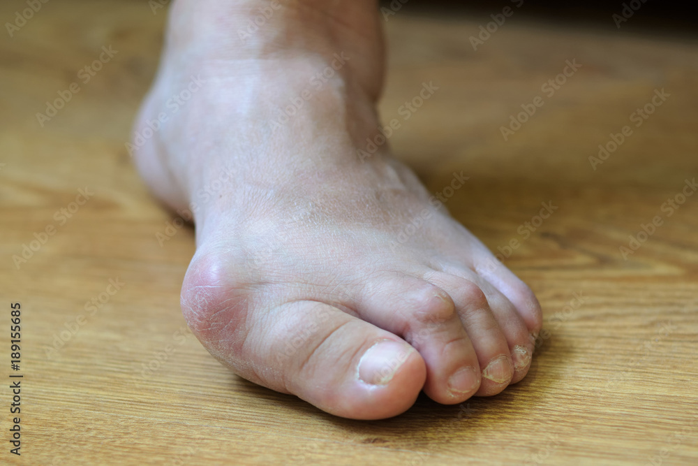 Problem foot with bunion (Hallux valgus) Problem foot with bunion (Hallux valgus)