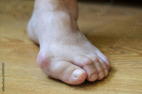 Problem foot with bunion (Hallux valgus) © GarkushaArt
