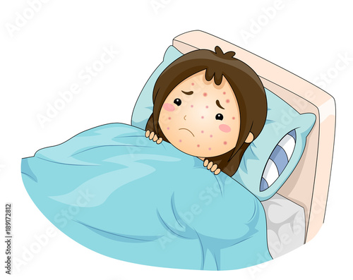 Kid Girl Chicken Pox Illustration