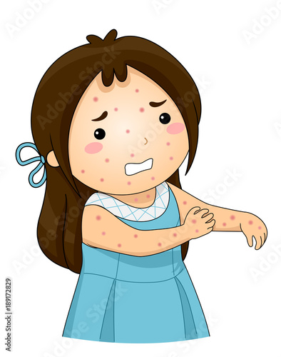 Kid Girl Chicken Pox Scratch Illustration