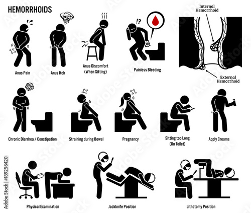 Hemorrhoids and Piles Icons. Pictogram and diagrams depicts signs, symptoms, diagnosis, examination, surgery, and treatment of hemorrhoids and piles by urologist and doctor.