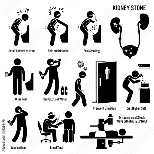 Kidney Stone Icons. Pictogram and diagrams depict signs, symptoms, diagnosis, and treatment of kidney stones. 
