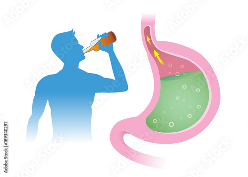 People have acid reflex in stomach from drink alcohol. Illustration about Gastroesophageal reflux disease.