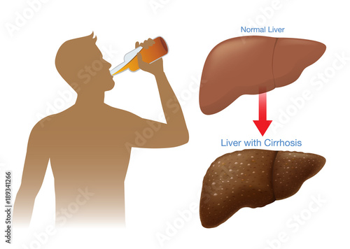 Normal liver of human change to the cirrhosis because drinking alcohol. Illustration about health and consume.