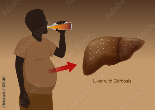 Liver with Cirrhosis of People who drink liqueur heavily over a long period of time. Illustration about health and medical.
