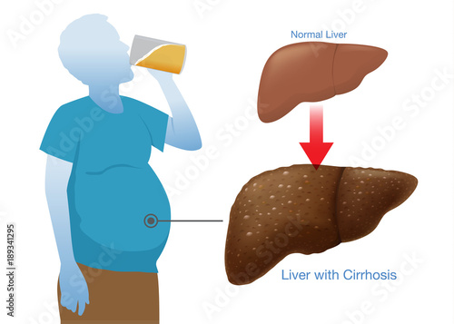 Man drink alcohol has a over big belly and his liver to become inflamed and swollen.
Illustration about physical of people who has a symptoms of cirrhosis.