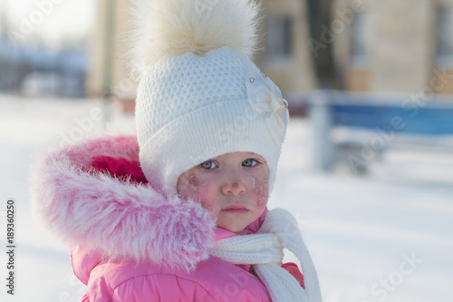 Fotografie beautiful baby girl with frostbitten face or with allergic rash on cheeks playin