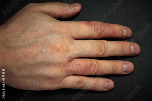 Hand dermatitis. Hand eczema