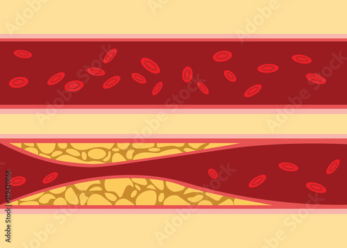 comparison between normal and unhealthy cholesterol human blood vein cell stream flow with fat on side with flat style illustration