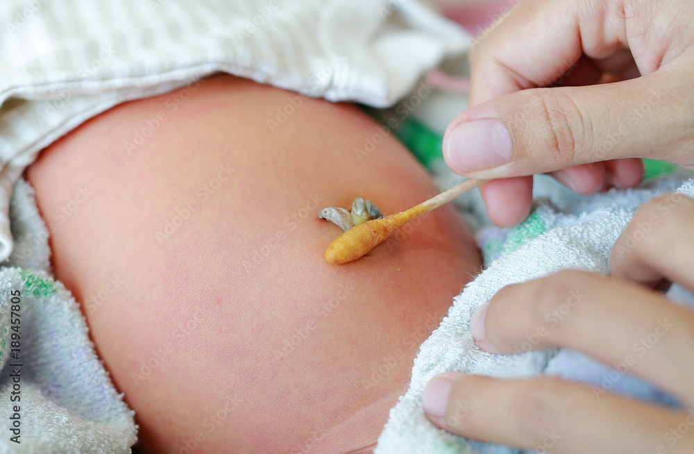 Mother use cotton swab moistened with alcohol to wipe clean the navel umbilical  cord baby newborn. Stock Photo | Adobe Stock