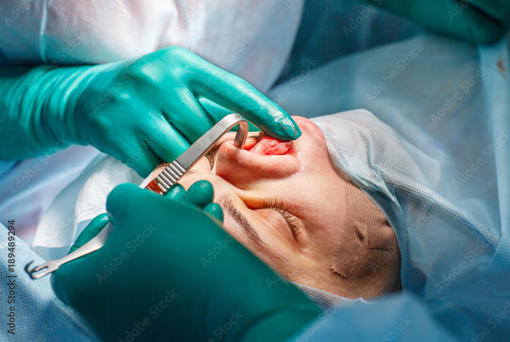 Plastic surgery of the nose in operating room, rhinoplasty Plastic surgery of the nose in operating room, rhinoplasty