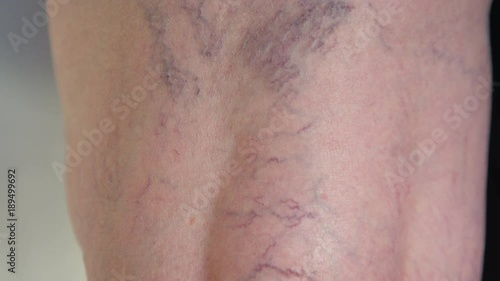 SLOW MOTION, CLOSE UP, MACRO: Twisting veins curving down the back of unrecognizable senior lady's knee. Close up examination of aging woman's coronary problem. Detailed shot of purple varicose veins. photo