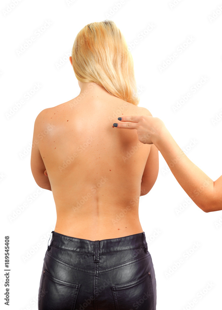 Female hand shows big birthmark on the female back Female hand shows big birthmark on the female back