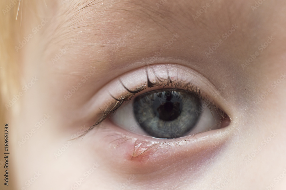 Illness person eye with sty and pus looking into the camera Illness person eye with sty and pus looking into the camera