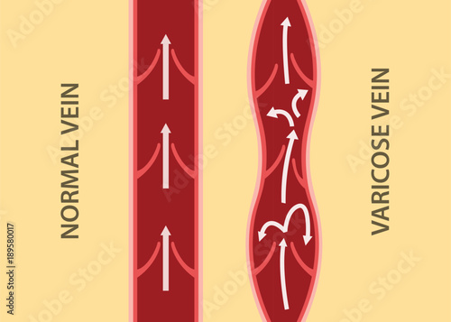 comparison compare between normal vein and varicose vein in vertical alignment
