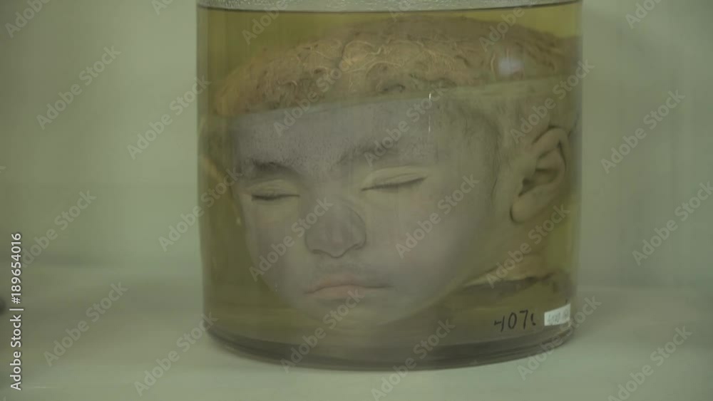 Wideo Stock Anatomical preserved human specimens, ugliness, anomalies. Human parts of the body