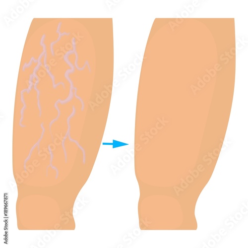 Varicose veins operation icon, cartoon style