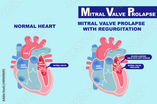 heart with mitral valve prolapse