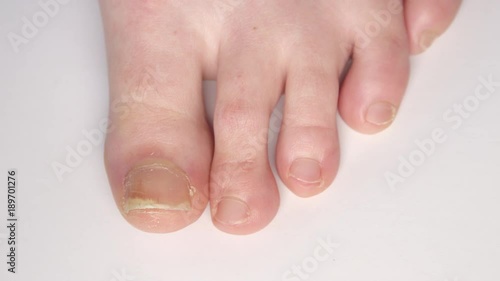 CLOSE UP: Detail of human foot & thickening psoriatic nails separating from nailbed. Thick yellow nails affected by fungus infection. Deformation, detachment, pitting. Psoriasis symptoms, dermatology photo