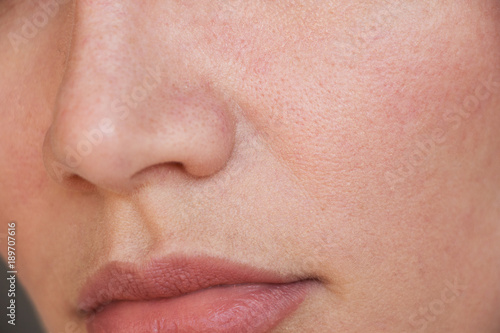 acne on the face. pores on the face
