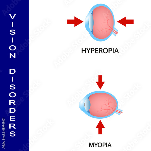 Vision disorders human,  science,  eye,  vision,  anatomy,  disease,  organ,