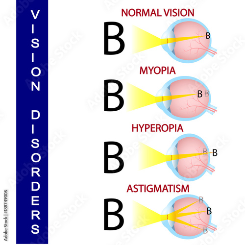 Vision disorders human,  science,  eye,  vision,  anatomy,  disease,  organ,