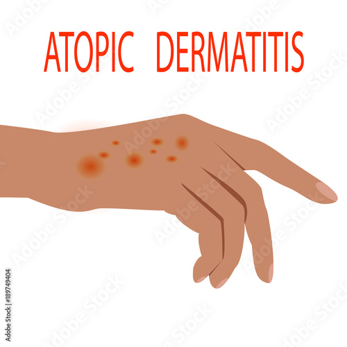 Atopic dermatitis health,  medical,  skin,  pain,  dermatitis,  eczema,