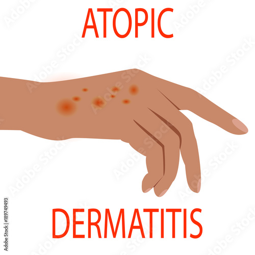 Atopic dermatitis health,  medical,  skin,  pain,  dermatitis,  eczema,