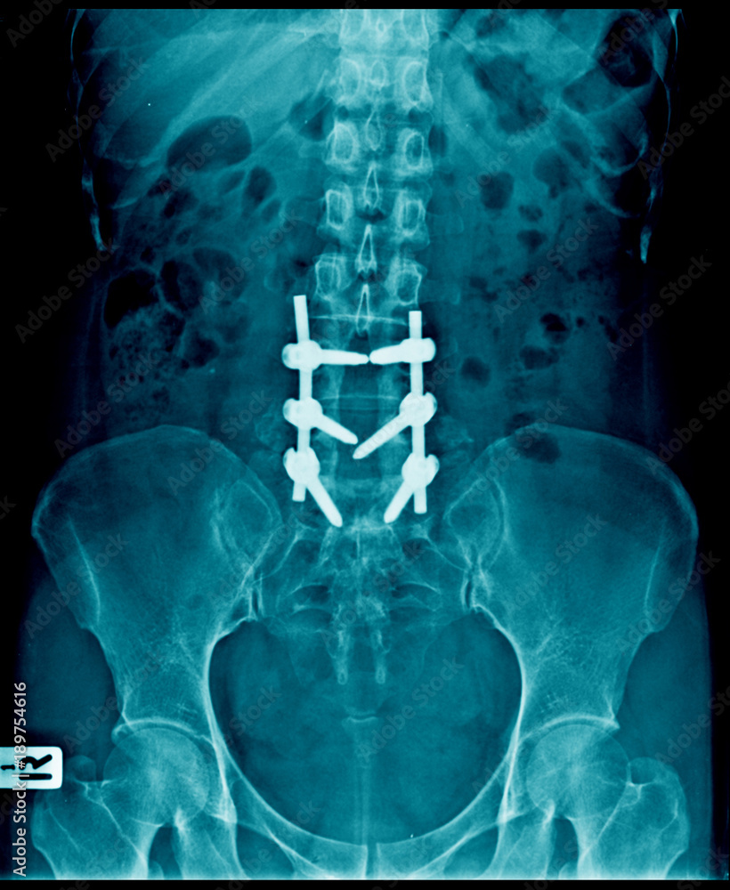 compression fracture and post operation to use internal fixation lumbar