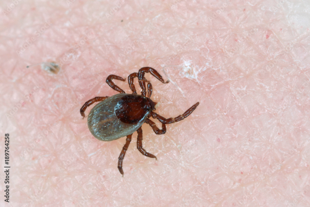 Tick Ixodes ricinus on human skin. tick wandering over human hand. Encephalitis tick. This kind of animal is a spreader of borrelia and tbe. Tick Ixodes ricinus on human skin. tick wandering over human hand. Encephalitis tick. This kind of animal is a spreader of borrelia and tbe.