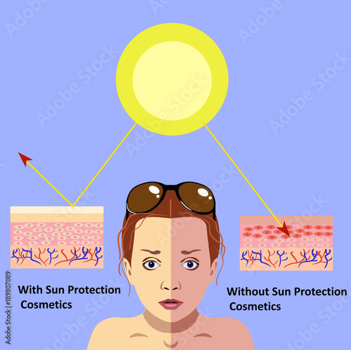 redness on woman facial and neck skin.Vector Illustration about danger of Ultraviolet