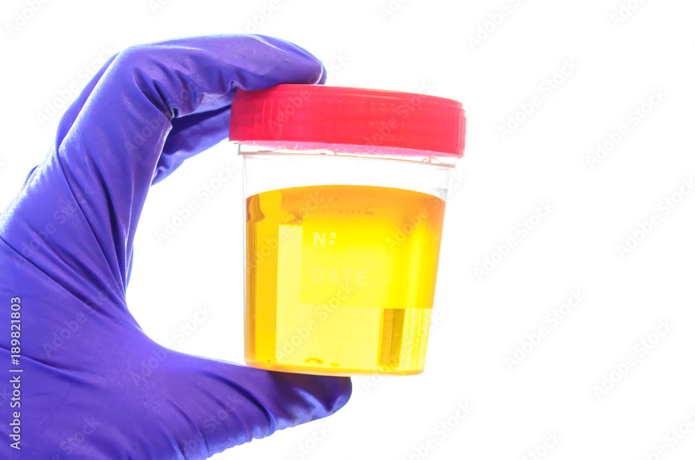 Urine specimen medical analysis. Urine analysis in the laboratory