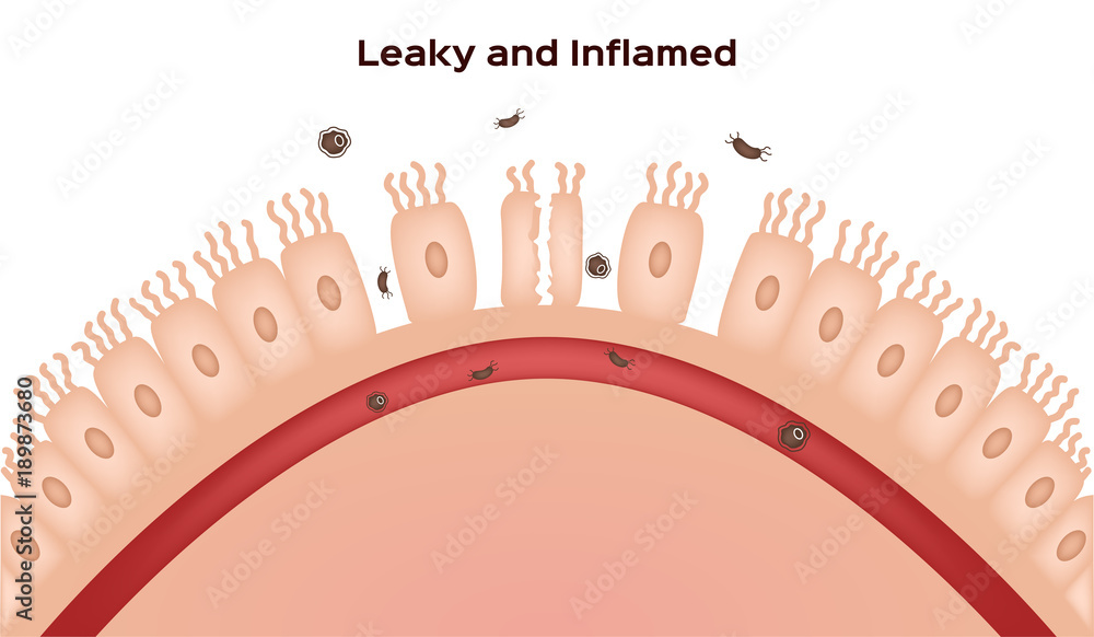 Celiac disease Small intestine lining damage. good and damaged villi