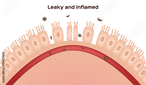 Celiac disease Small intestine lining damage. good and damaged villi . leaky gut progression