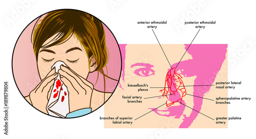 vector medical illustration of the symptoms of epistaxis (nosebleed) photo