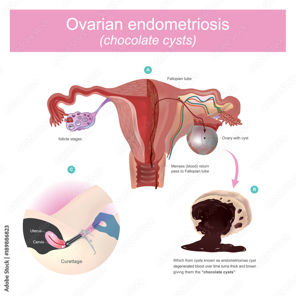 Ovarian lesions may trap menstruating blood, which from cysts known as  endometriosis Degenerated blood over time turns thick and brown giving them  the name chocolate cysts. Stock Vector