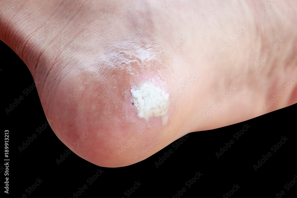 close up pain foot corn isolated on black background with clipping