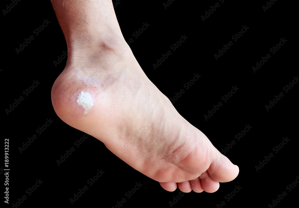 Black top corn foot