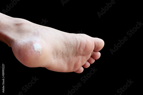 close up pain foot corn isolated on black background with clipping path