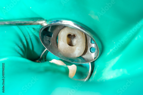 close-up of a human rotten carious tooth at the treatment stage in a dental clinic photo