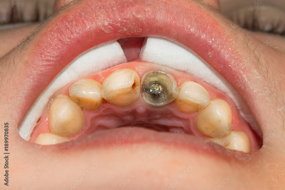 close-up of a human rotten carious tooth at the treatment stage in a dental clinic close-up of a human rotten carious tooth at the treatment stage in a dental clinic