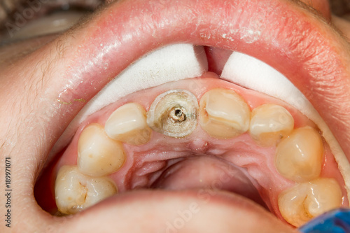 closeup treated human tooth in a dental filling rotten clinic