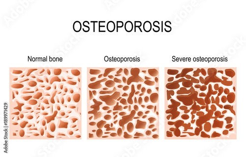 Osteoporosis - is a disease of bones that leads to an increased risk of fracture.