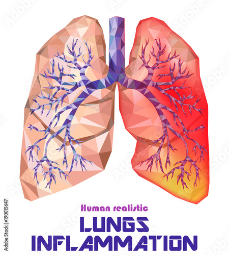 Low poly realistic human lungs and bronchus with cancer inflammation disease. Vector.