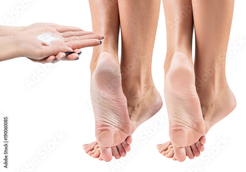 Feet with dry skin before and after treatment.