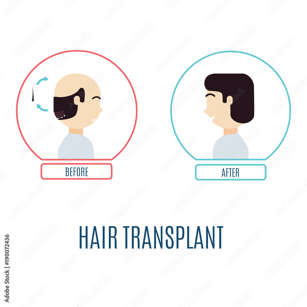 Hair transplantation infographics. Patient with alopecia before and after the procedure. Hair loss medical treatment. Faceless man, no identity concept. Vector illustration for transplantation clinics Hair transplantation infographics. Patient with alopecia before and after the procedure. Hair loss medical treatment. Faceless man, no identity concept. Vector illustration for transplantation clinics