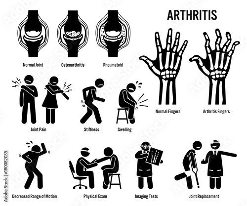 Arthritis, Joint Pain, and Joint Disease Icons. Pictograms depict arthritis signs, symptoms, diagnosis, and treatment. Icons include bones for osteoarthritis and rheumatoid arthritis.