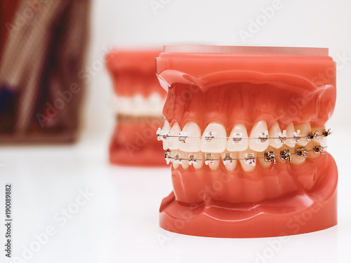 Dentist demonstration teeth model of orthodontic bracket system