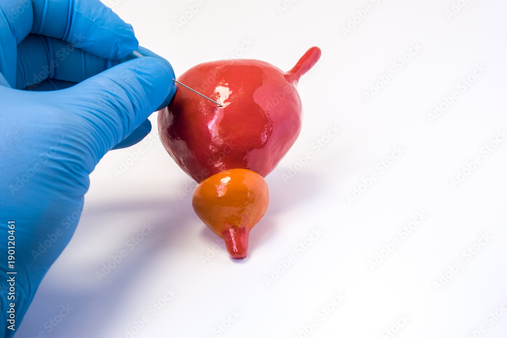 Urine bladder suprapubic puncture biopsy or cystoscopy procedure